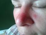 Красные пятна на лице в районе носа фото 2