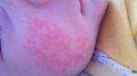 Аллергия на лице у ребенка фото 1