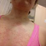 Аллергия на коже фото 2