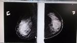 Расшифровка маммографии фото 1