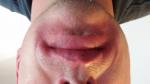 Воспаление и мокнутие кожи вокруг губ фото 1
