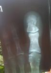 Перелом большого пальца ноги со смещением фото 1