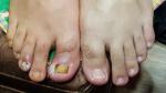 Незаживающая рана на большом пальце ноги фото 3