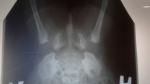 Рентген тазобедренных суставов - норма или нет? фото 1
