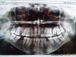 Панорамный снимок зубов, киста фото 1
