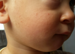 У ребенка сыпь на щеках, плечах и бедрах фото 3