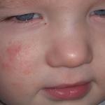 Аллергия на щеках фото 1