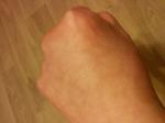 Травма сустава на кисти руки, выбита косточка фото 1