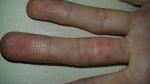 Непонятные прищики на пальце и лимфи узлы в лотком згибе фото 1
