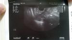 Снимок гинекологического УЗИ, боли в левом яичнике фото 1