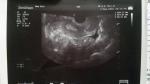 Снимок гинекологического УЗИ, боли в левом яичнике фото 3