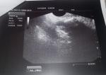 Подозрение на фиброматоз фото 2