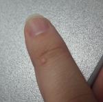 Болячка на пальце фото 1