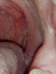Папиллома или воспаленное горло? фото 1