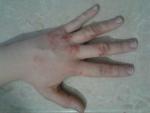 Проблема с кожным покровом кистей рук фото 2