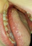 Воспаление языка и боли в горле фото 1