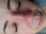 Опухание носа после операции фото 2