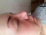 Опухание носа после операции фото 1