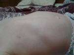 Деформация грудной клетки у ребенка после операци фото 1