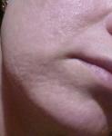 Причины и лечение выпячивания сальных желез на коже лица фото 3