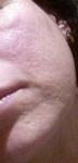 Причины и лечение выпячивания сальных желез на коже лица фото 2