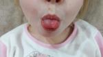 Болезненные шишечки на языке у ребенка фото 1