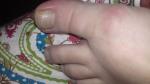 Грибок ногтей при беременности фото 2