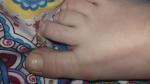 Грибок ногтей при беременности фото 1