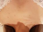 Сыпь в области груди и спины фото 1