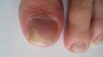 Паразитарные грибы на ногте лечение фото 2