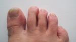 Анализ грибка ногтей лечение фото 3
