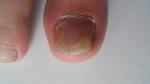 Паразитарные грибы на ногте лечение фото 4