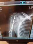 Перелом плечевой кости фото 1