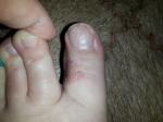 Покраснение и шелушение кожи на пальце ноги фото 2
