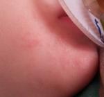 Шелугащиеся пятна на лице у ребёнка фото 1