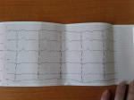 Электрокардиограмма при болях в сердце фото 2