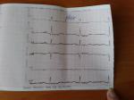 Электрокардиограмма при болях в сердце фото 3