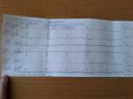 Электрокардиограмма при болях в сердце фото 1