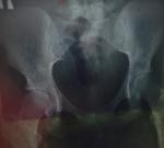 Рентген костей таза фото 1