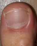 Опух палец на ноге фото 1