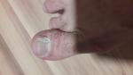 Шелушение пальца на ноге и неровность ногтя фото 1