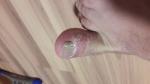 Шелушение пальца на ноге и неровность ногтя фото 2