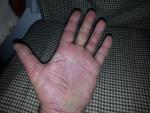 Холодовая аллергия на ладонях рук, растрескивание кожи и зуд фото 1