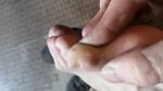 Кожанное заболевание пальцев ног фото 3