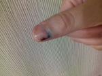 Палец разрыв тканей фото 3