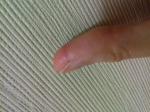 Палец разрыв тканей фото 1