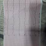 Отклонение в кардиограмме фото 3