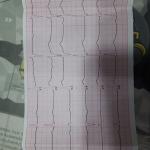 Отклонение в кардиограмме фото 4