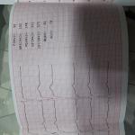 Отклонение в кардиограмме фото 5