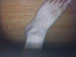 Болячка на ноге фото 2